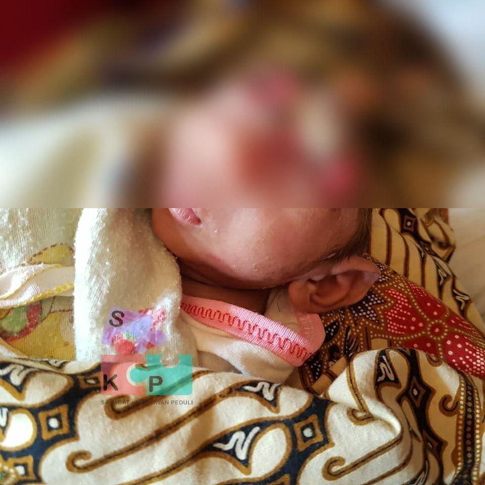 Bayi 29 Hari Ini Bertahan Hidup Tanpa Otak dan Tengkorak