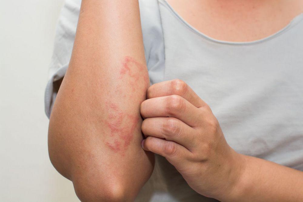 7 Treatment yang Perlu Diterapkan Ketika Mengalami Eczema