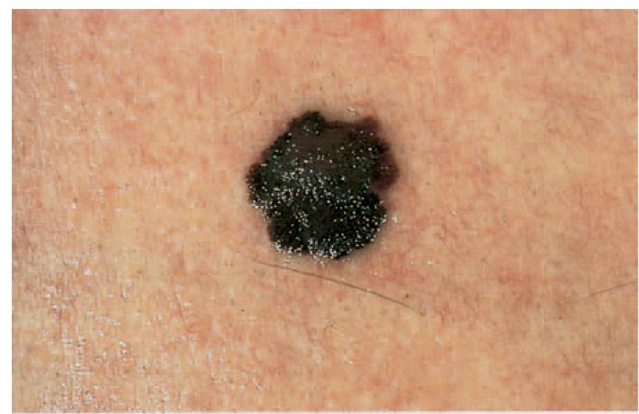 skincancer.org