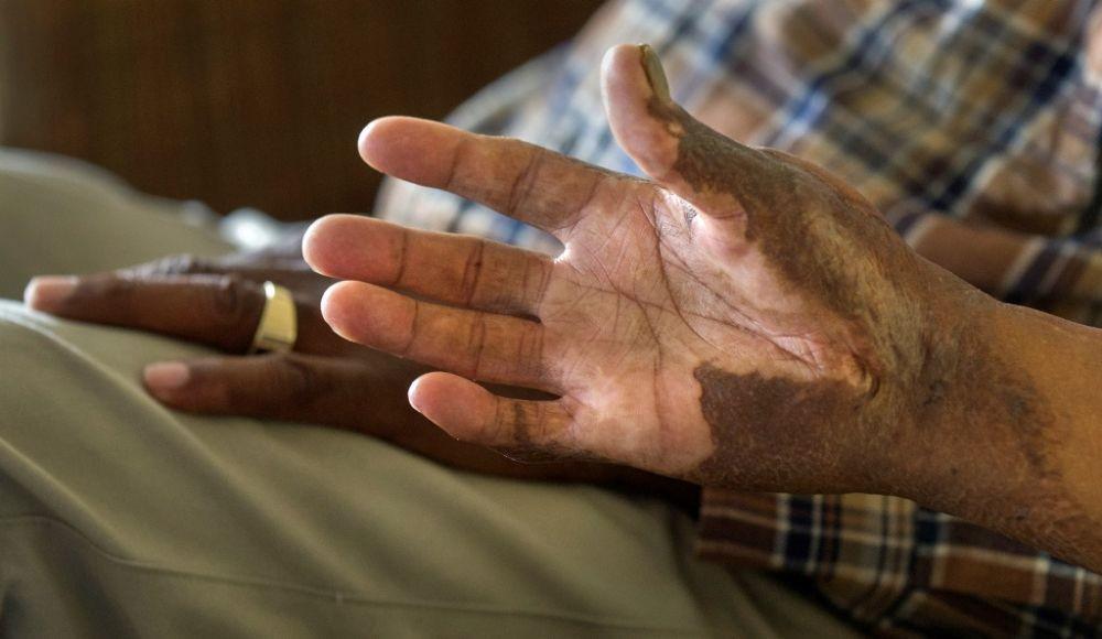Prajurit TNI Korban Jatuhnya Heli M-17 Ditangani Dokter Bedah Plastik