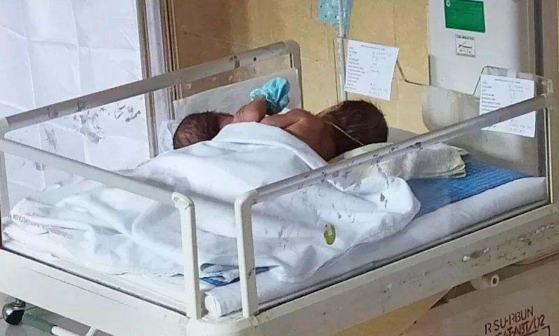 Miris, Ibu di Kalteng Lahirkan Bayi Kembar Siam Dempet Tanpa Keluarga