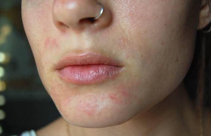eczema-prevent.blogspot.com