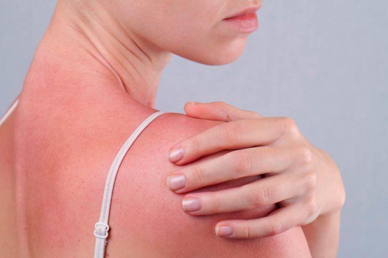 7 Fakta Penting Sunburn, Kulit yang Terbakar Matahari