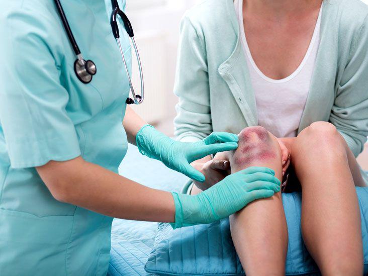 Sering Memar, Waspada Penyakit Idiopatik Trombositopeni Purpura