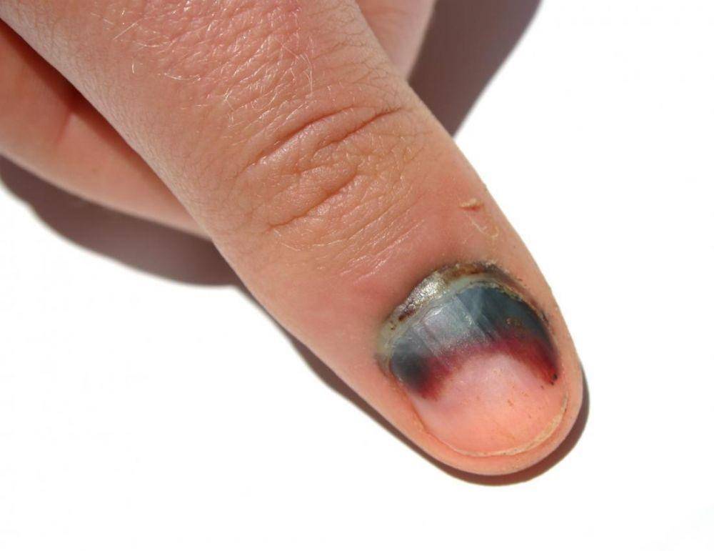 ilustrasi hematoma subungual (medicalnewstoday.com)
