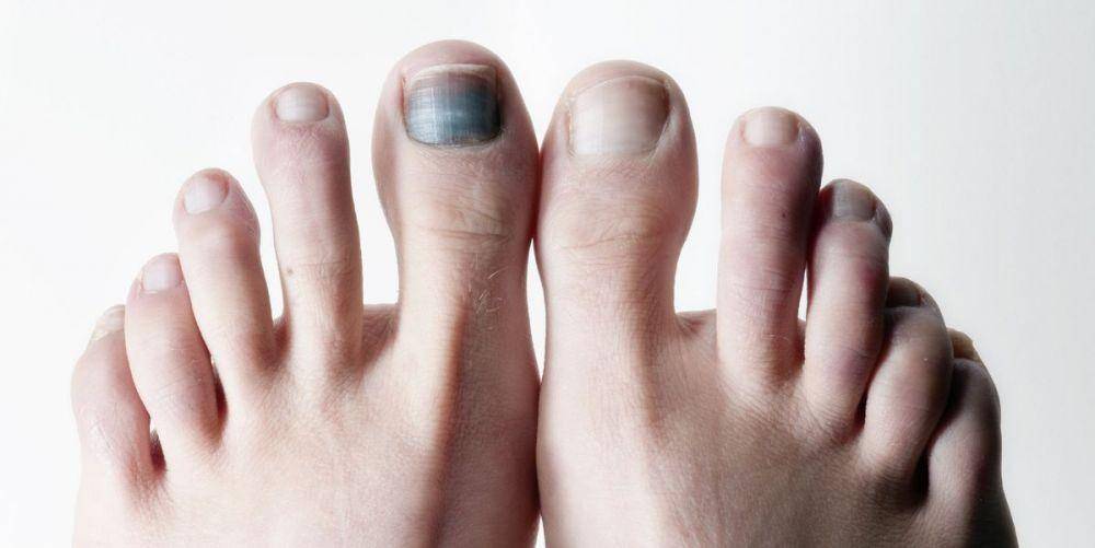 ilustrasi hematoma subungual (runnersworld.com)