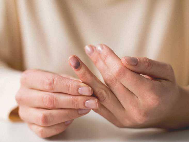 ilustrasi hematoma subungual (healthline.com)