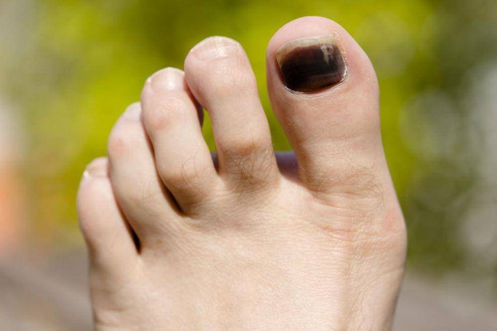 ilustrasi kuku kaki yang menghitam (dermaclue.com)