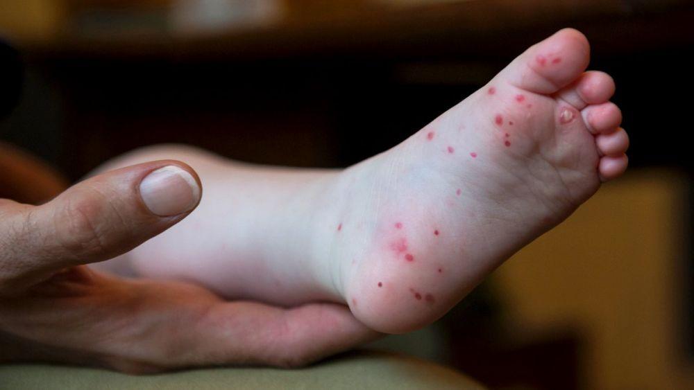 5 Cara Menangani dan Mengobati Flu Singapura, Sebelum Makin Parah