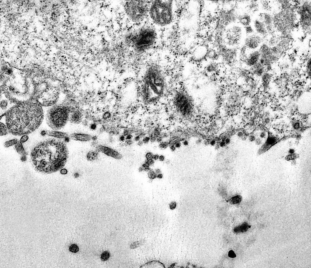 [FOTO] Ini Tampak Asli Virus Corona saat Menginfeksi Sel Tubuh Manusia