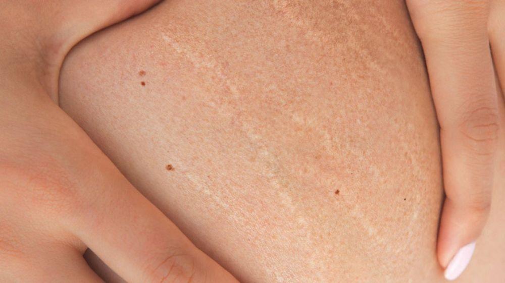 7 Penyebab Munculnya Stretch Mark yang Perlu Kamu Tahu