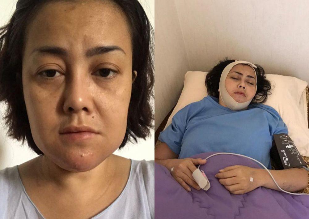 5 Fakta Kondisi Rency Milano, Dagu Bernanah Diduga Korban Malapraktik