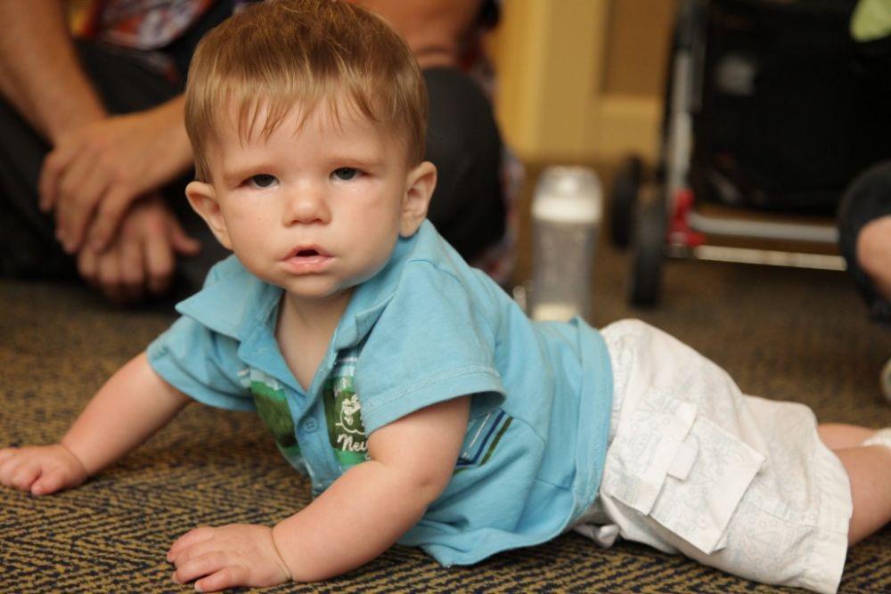 Viral Kisah Bayi Hiro yang Punya Moebius Syndrome, Penyakit Apa Itu?