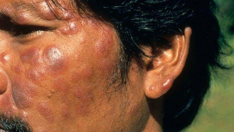 The Leprosy Mission International