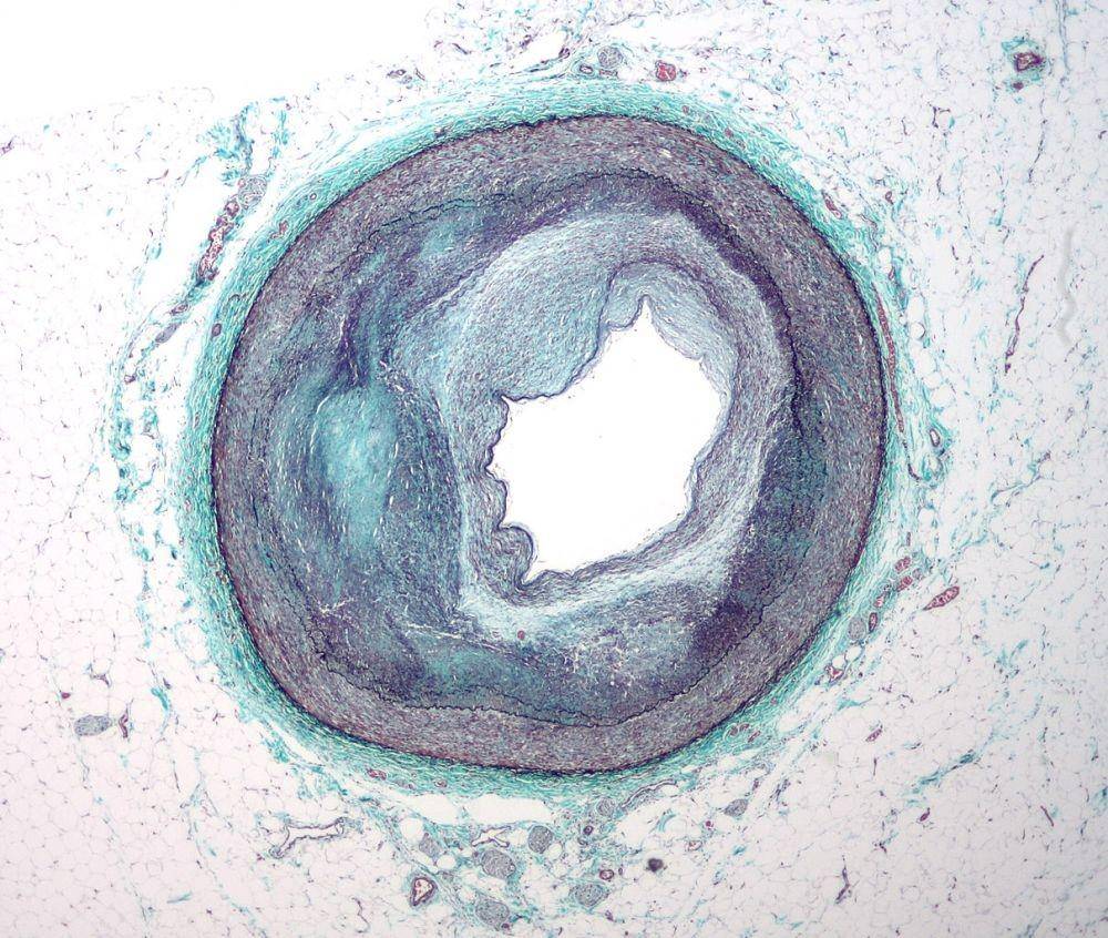ilustrasi aterosklerosis (commons.wikimedia.org/National Heart Lung and Blood Insitute)
