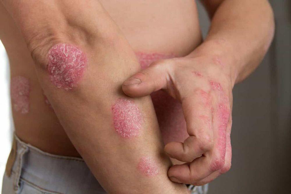 Waspadai, Psoriasis Mampu Sebabkan 12 Komplikasi Penyakit Ini