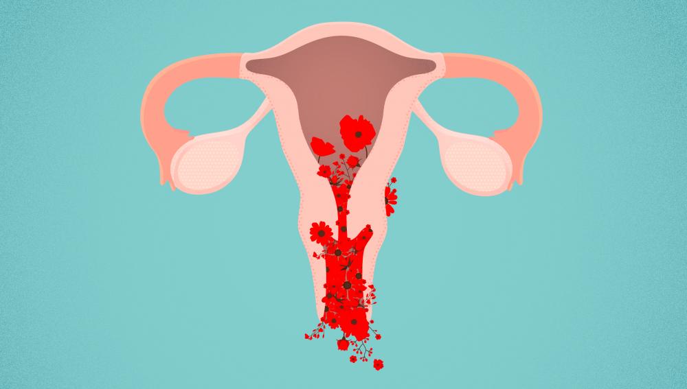 Ini Penyebab Menorrhagia, Menstruasi Deras Lebih dari Seminggu
