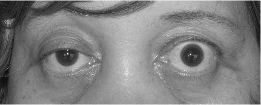 Ptosis atau kelopak mata terkulai pada pasien dengan myasthenia gravis. (jmedicalcasereports.biomedcentral.com)