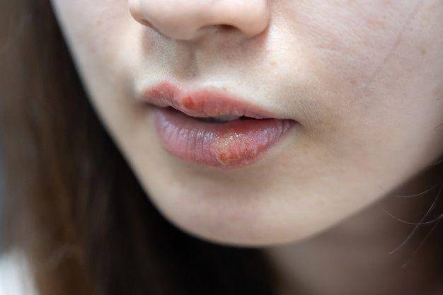 ilustrasi herpes labialis di sekitar mulut (freepik.com/@user6332637)