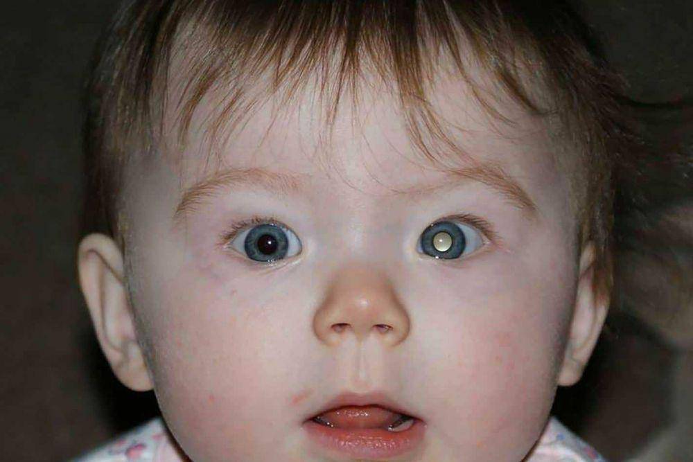 ilustrasi retinoblastoma pada balita (ihv.org.uk)