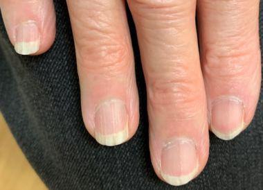 Brittle Nail Syndrome: Penyebab, Gejala, Pengobatan, dan Pencegahan