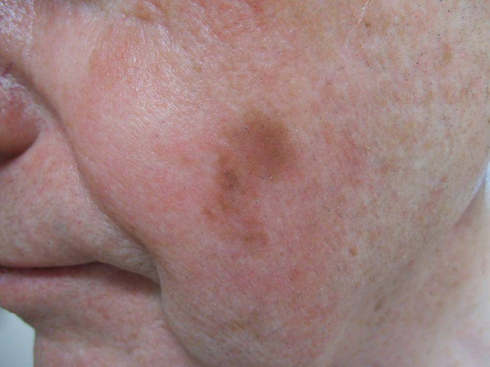ilustrasi lentigo maligna melanoma (commons.m.wikimedia.org/Omar Bari, Philip R. Cohen)