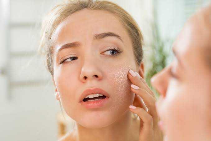 6 Cara Mengatasi Kulit Dehidrasi, Jangan Sampai Muncul Masalah Serius!