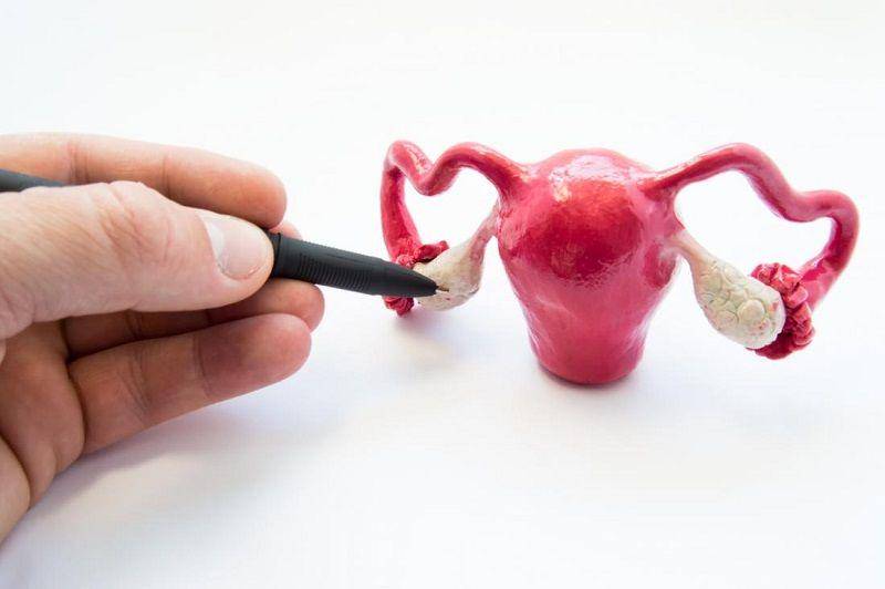 ilustrasi kista ovarium (medicalnewstoday.com)