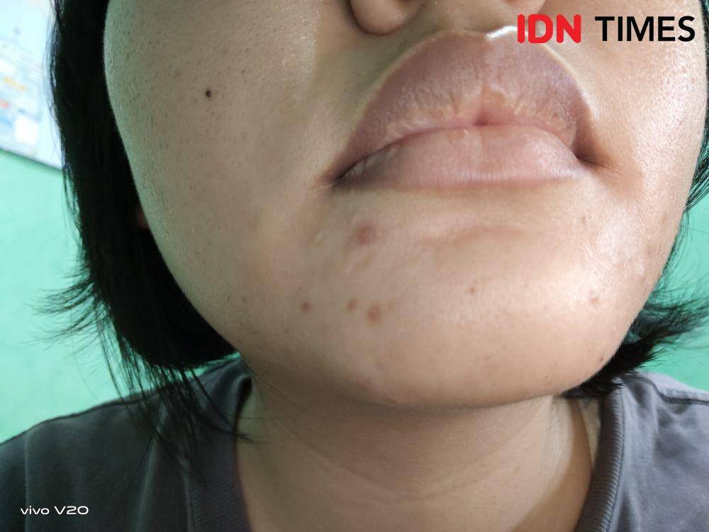 Bekas jerawat kehitaman. IDN Times/Febriyanti Revitasari