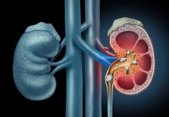 ilustrasi batu ginjal (health.harvard.edu)