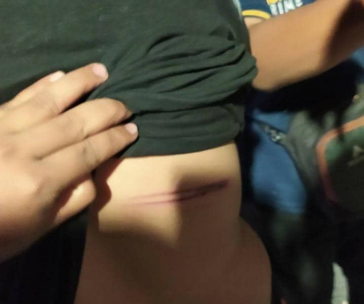 Bekas luka milik Shafa Wardany, persma Polinema yang ditangkap oleh polisi saat meliput demo Omnibus Law di Grahadi, Kamis (8/10/2020).
