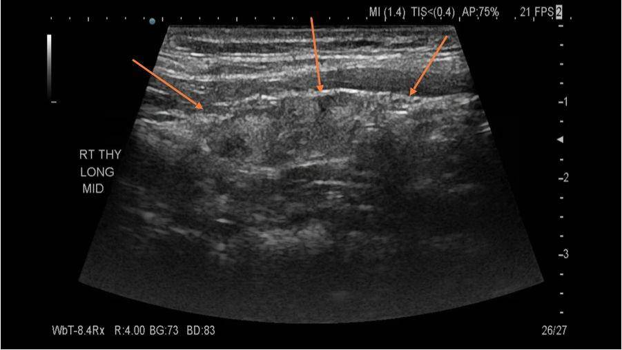 thyroidcancer.com