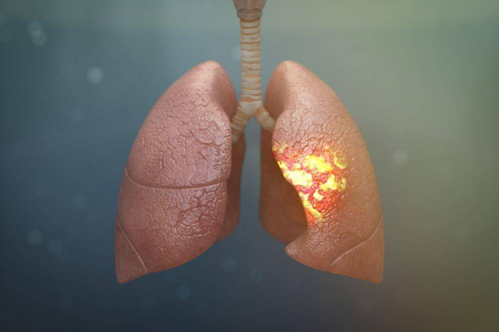 ilustrasi pneumonia (webmd.com)