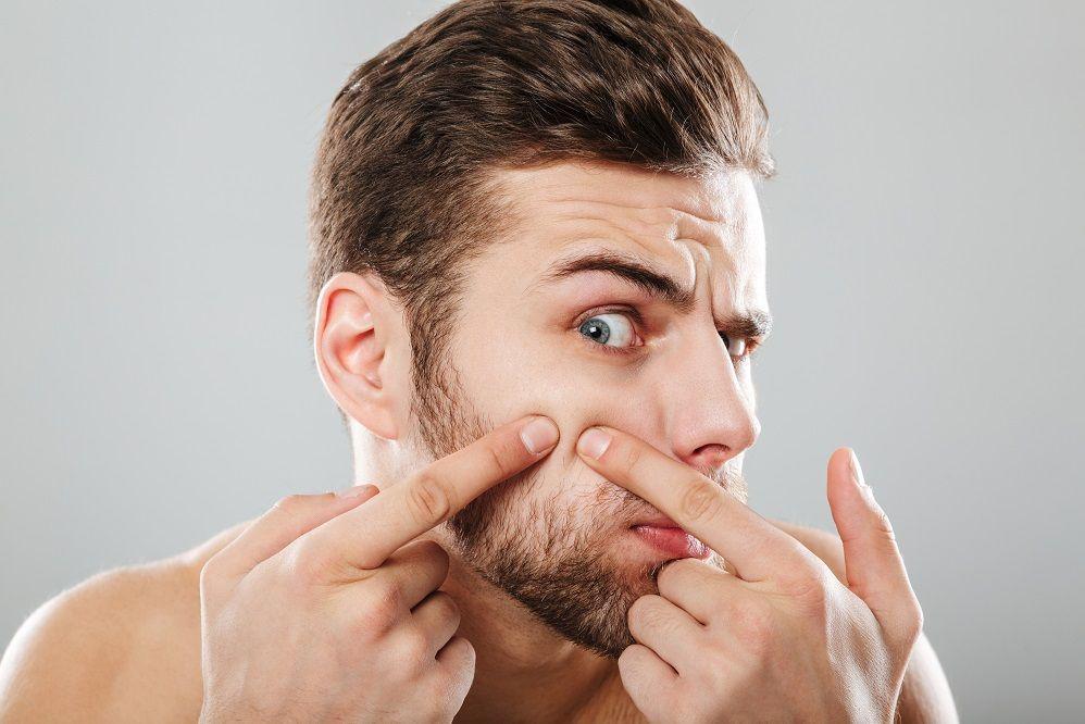 5 Tips Aman Bikin Jerawat Cepat Kempes dalam Semalam, Gak Usah Ragu!