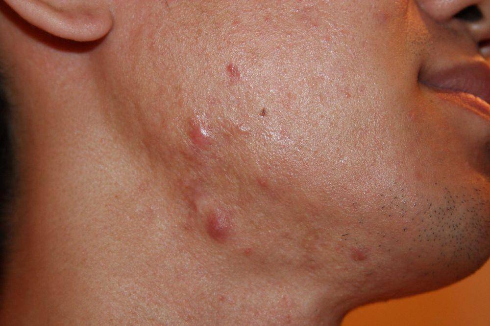 keloid212.com