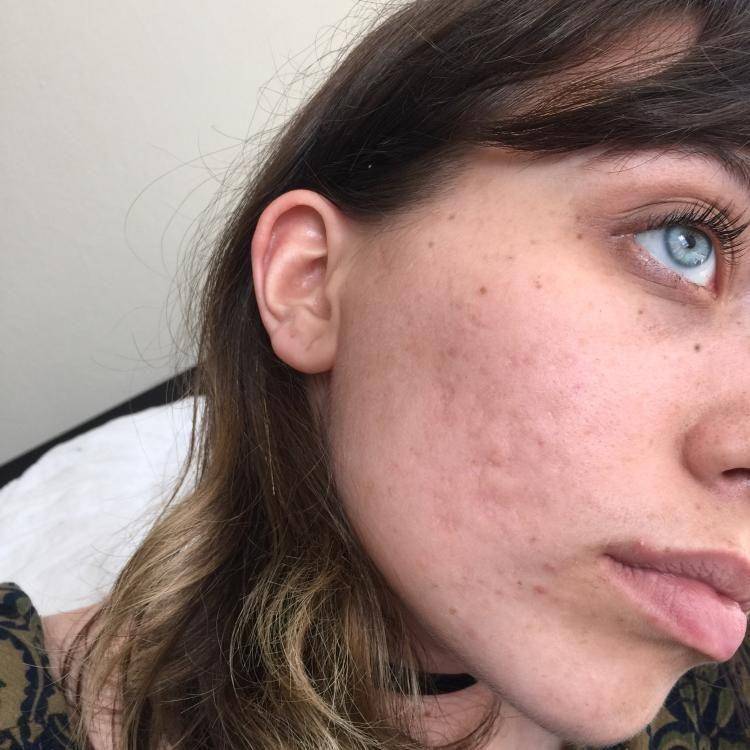 acne.org