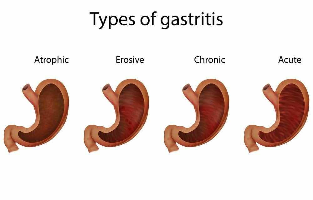 ilustrasi jenis gastritis (12healthy.com)