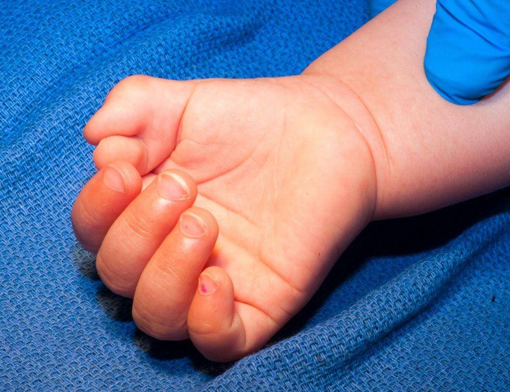 congenitalhand.wustl.edu