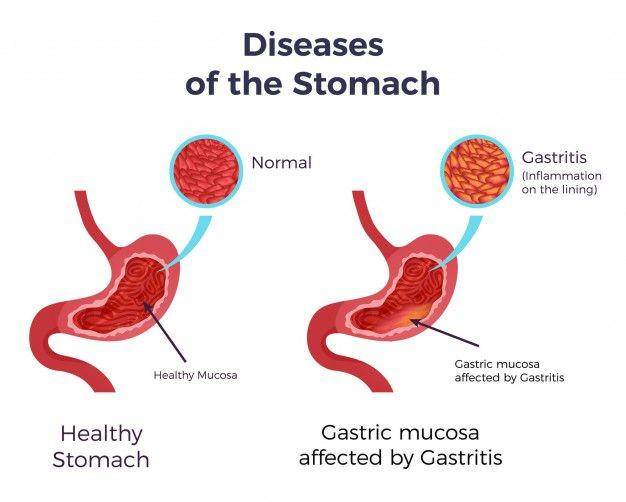 ilustrasi gastritis (freepik.com/macrovector)