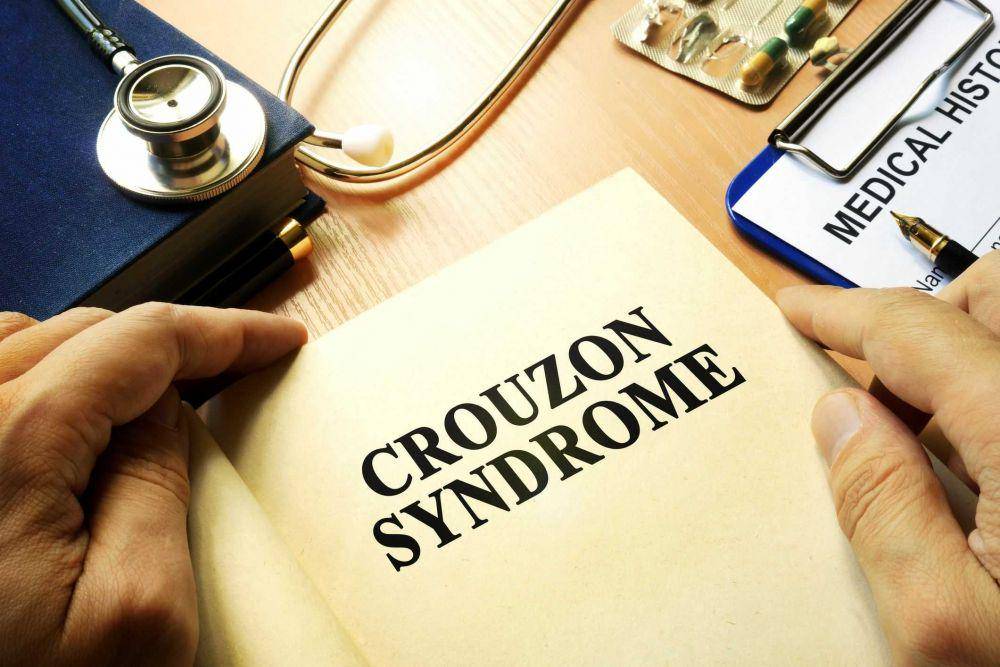 ilustrasi sindrom Crouzon (verywellheatlh.com)