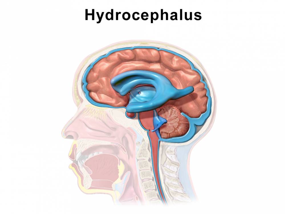 ilustrasi hidrosefalus (commons.wikimedia.org/BruceBlaus)