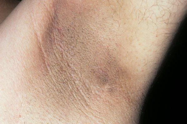 Akantosis Nigrikans: Penyebab, Gejala, Diagnosis, Pengobatan