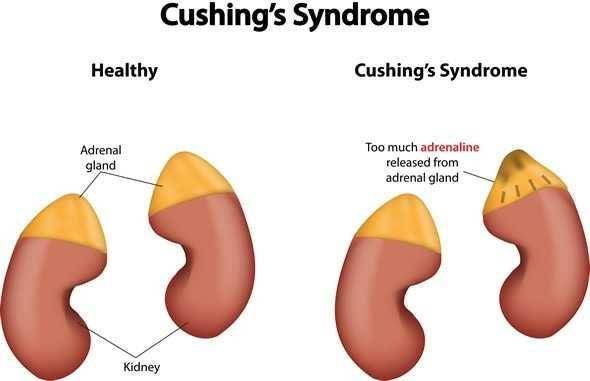 ilustrasi sindrom Cushing (news-medical.net)