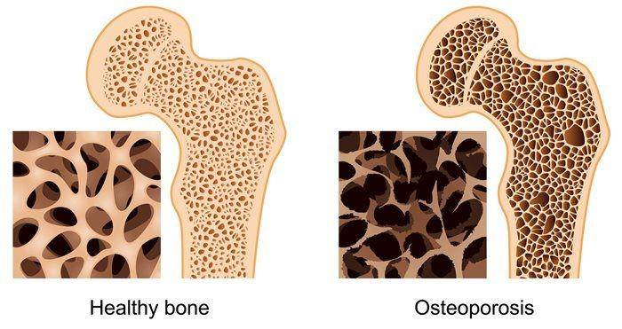 ilustrasi osteoporosis (msfocus.org)
