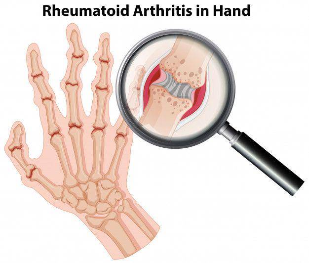 ilustrasi rheumatoid arthritis (freepik.com/brgfx)
