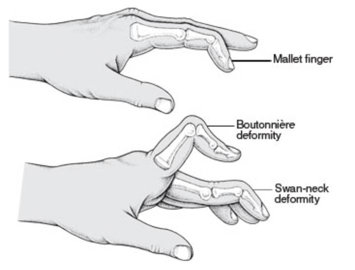 ilustrasi gejala pada rheumatoid arthritis (coreem.net)