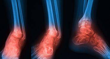 Osteomielitis disebabkan karena infeksi bakteri pada tulang. axishospital.co