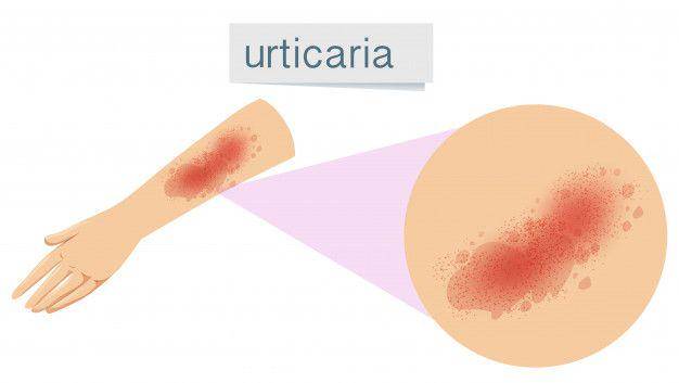 ilustrasi urtikaria atau biduran atau alergi dingin (freepik.com/brgfx)