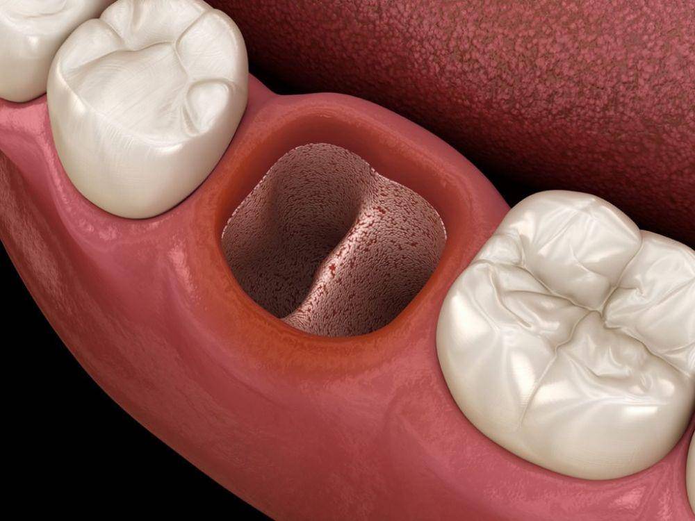 ilustrasi dry socket (askthedentist.com)