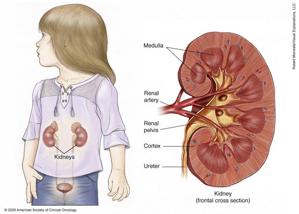 ilustrasi tumor Wilms (cancer.net)